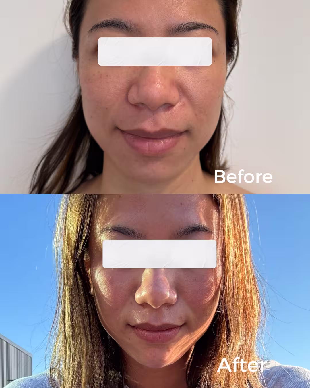 Dermal filler before and after results at JLoo Beauty Experts NYC