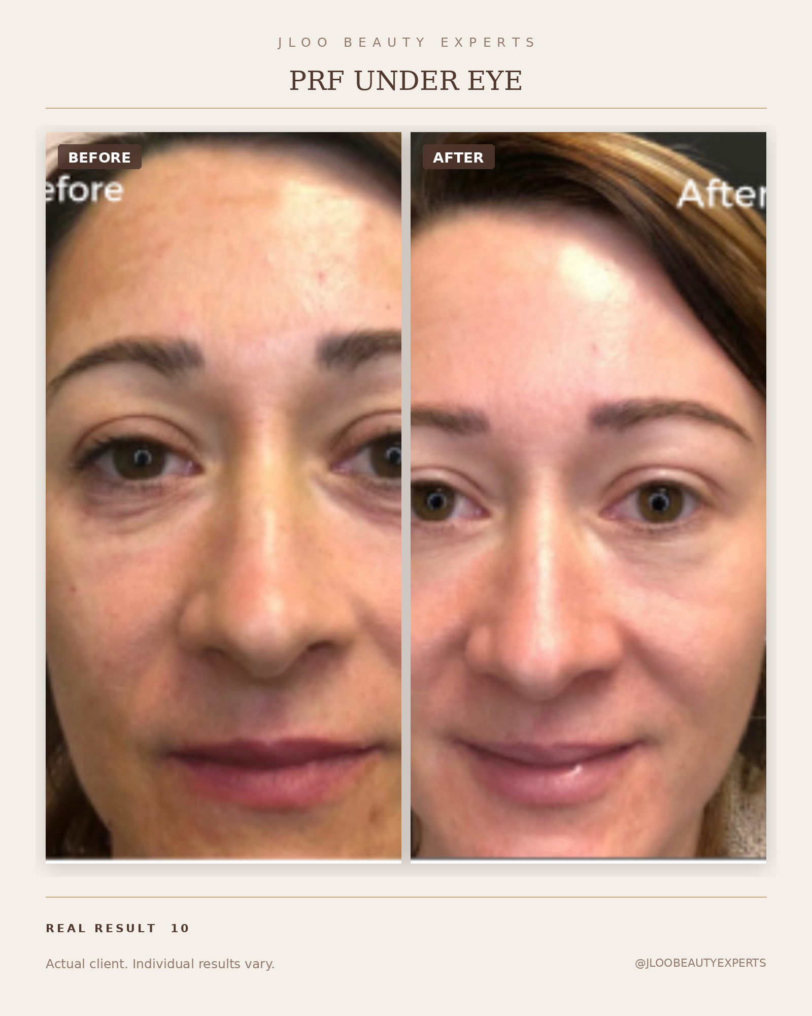 PRF under-eye before and after at JLoo Beauty Experts NYC