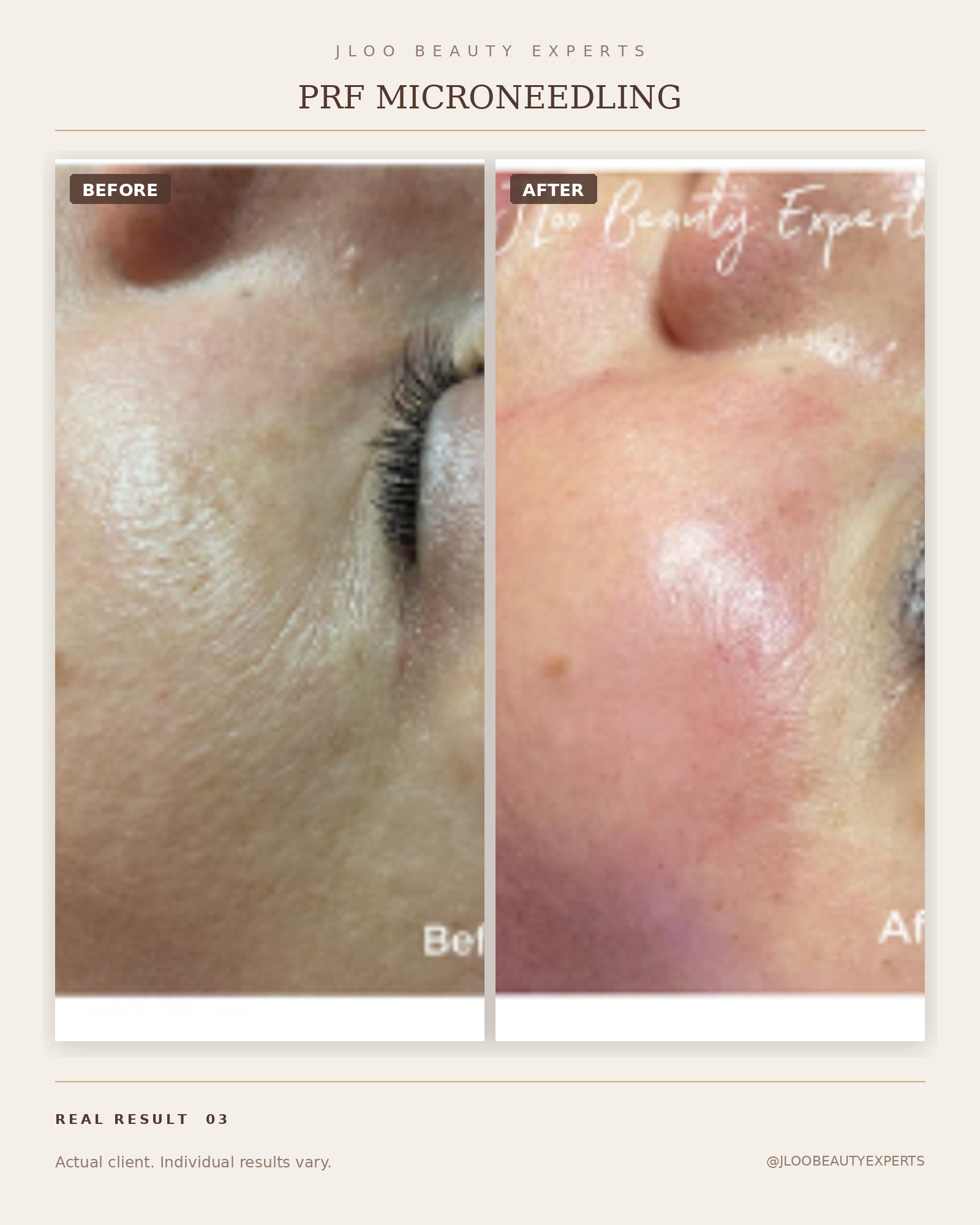 PRF Microneedling before and after in Midtown Manhattan