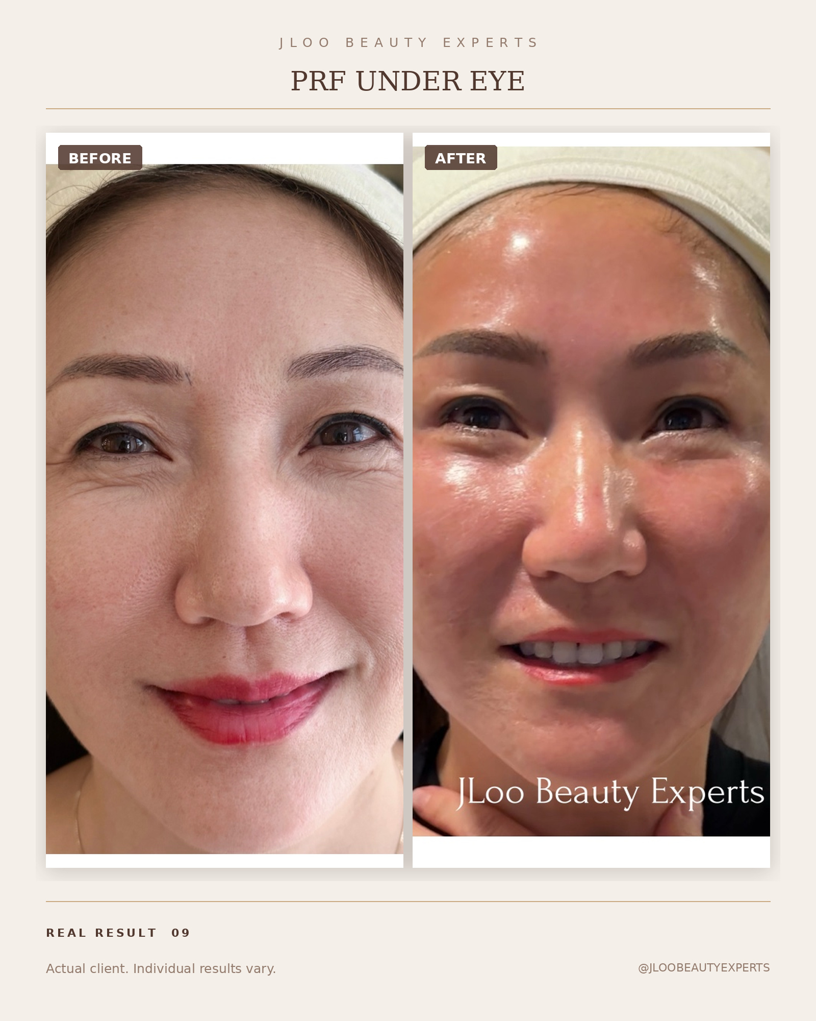 PRF under-eye treatment before and after results
