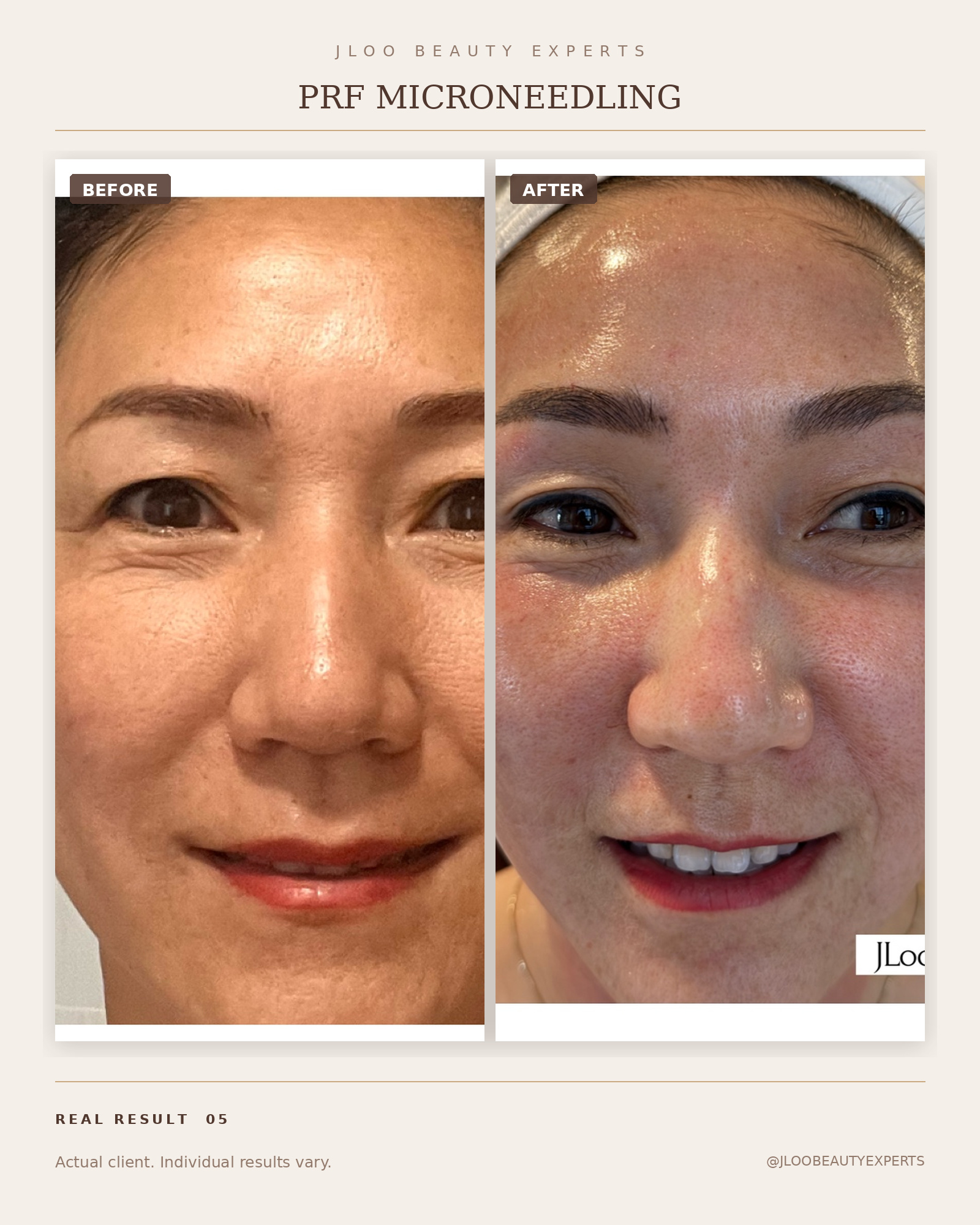 PRF Microneedling collagen results, before and after