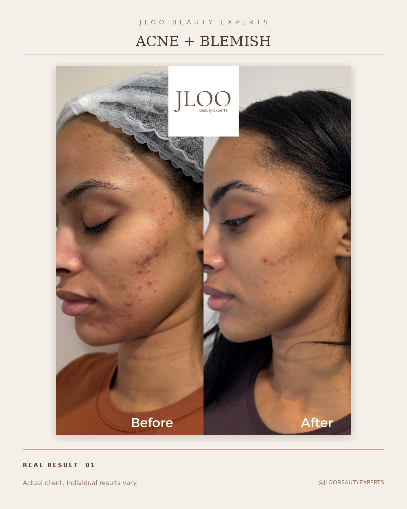 Acne and blemish treatment before and after