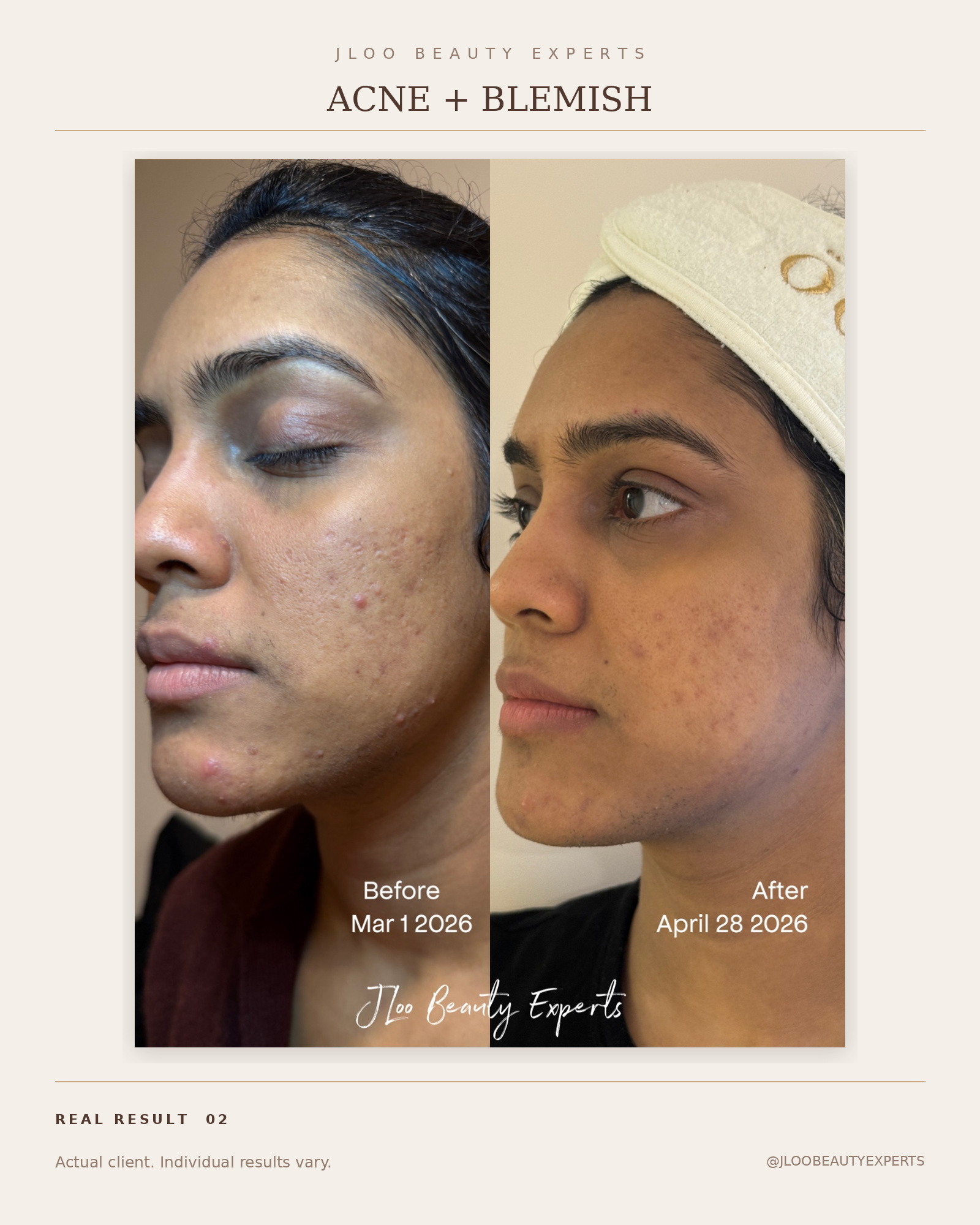 Clearer skin after acne treatment at JLoo