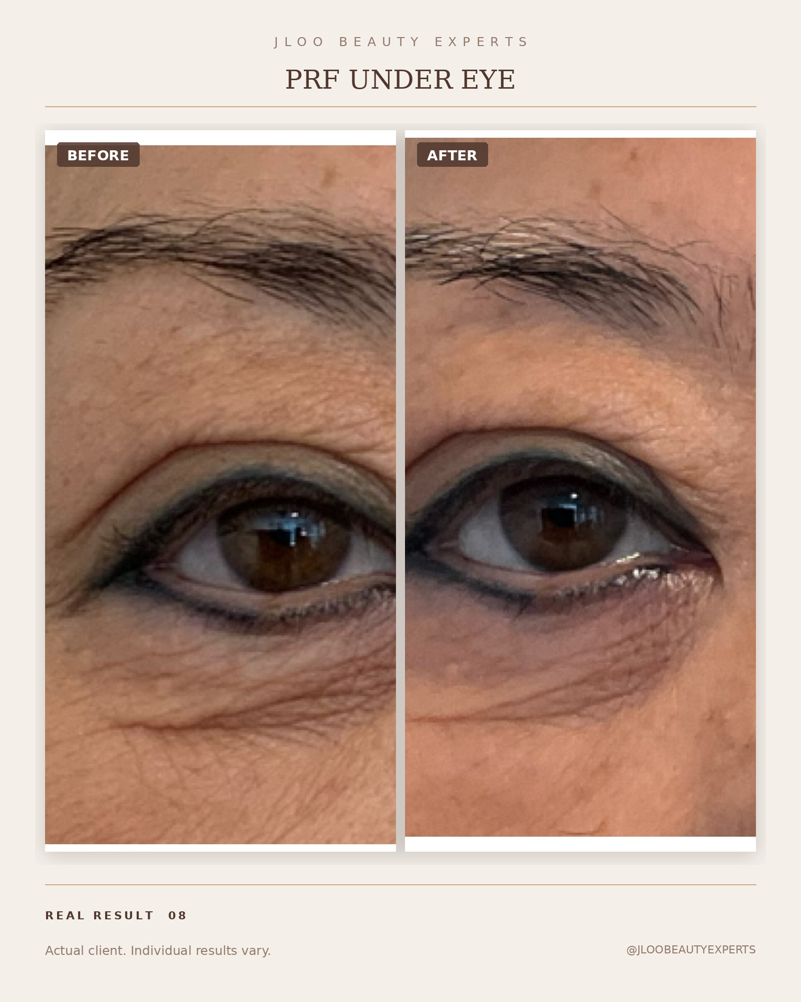 Under-eye PRF results, before and after