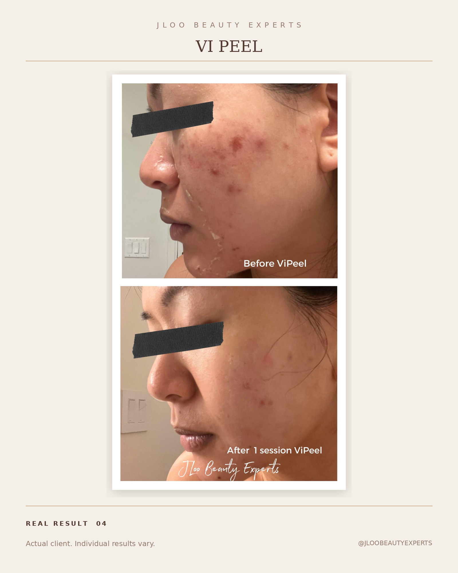 VI Peel before and after results