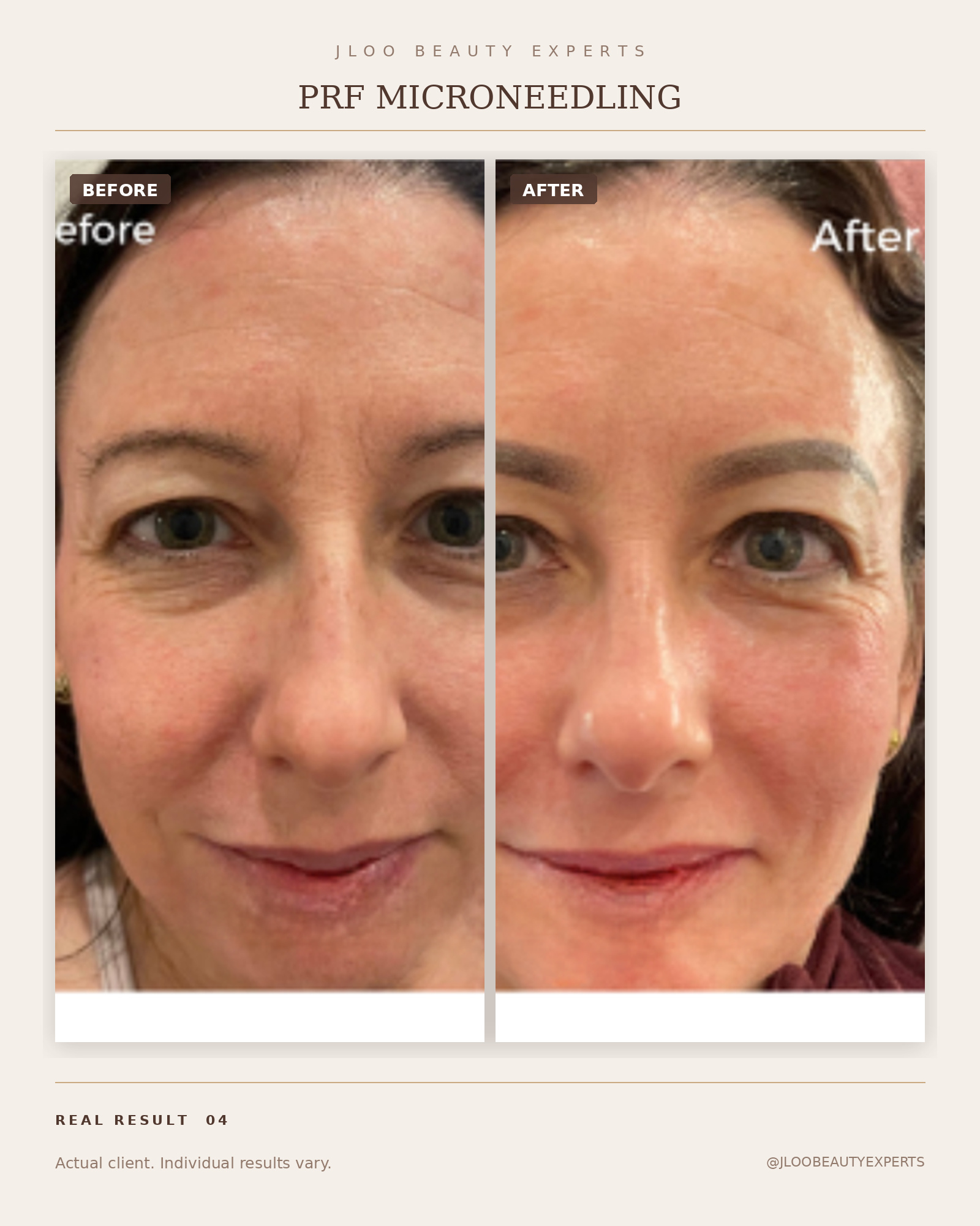 PRF Microneedling skin texture results