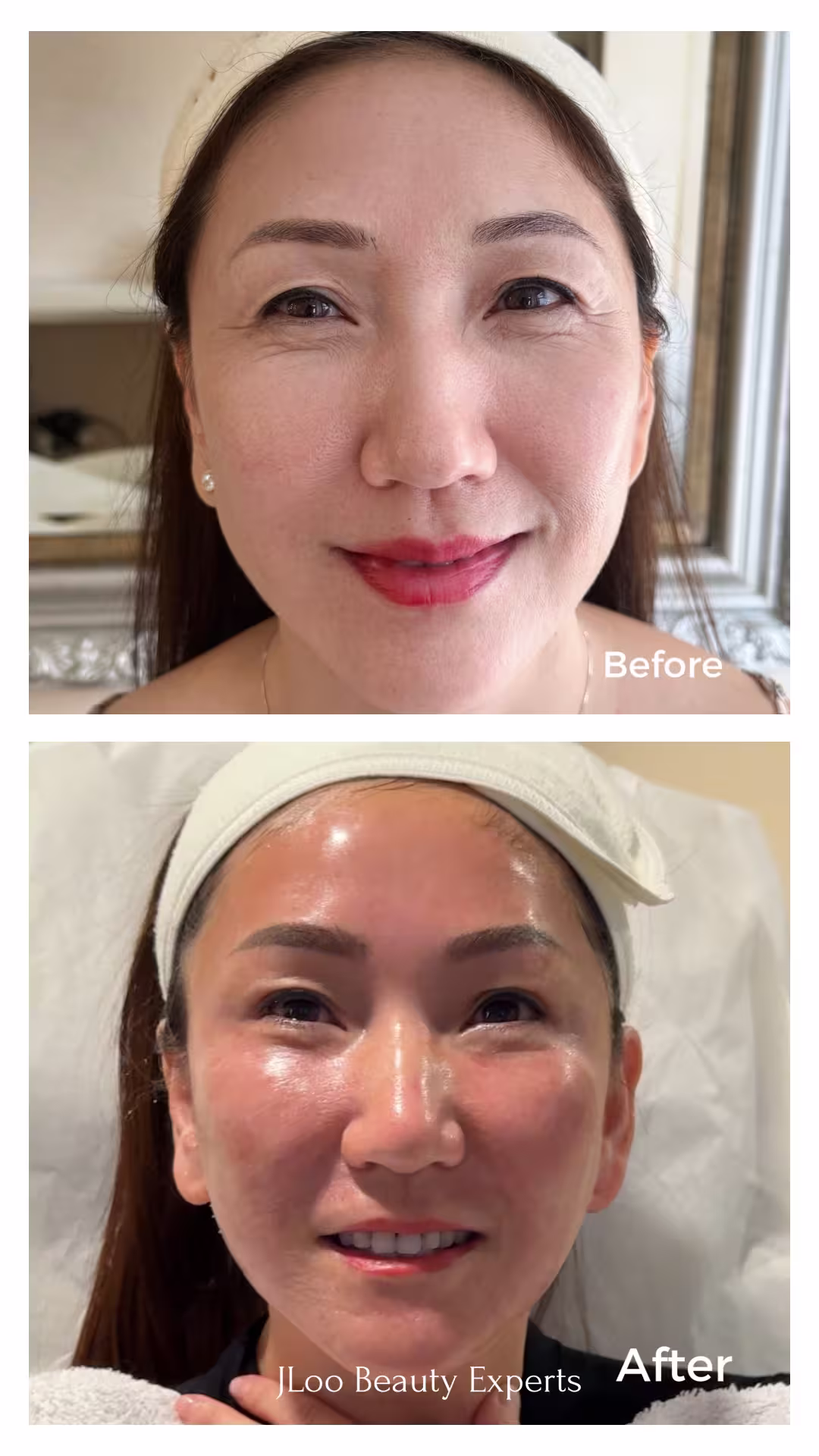 PRF EzGel vs. Filler for Undereye Hollows: What NYC Clients Should Know