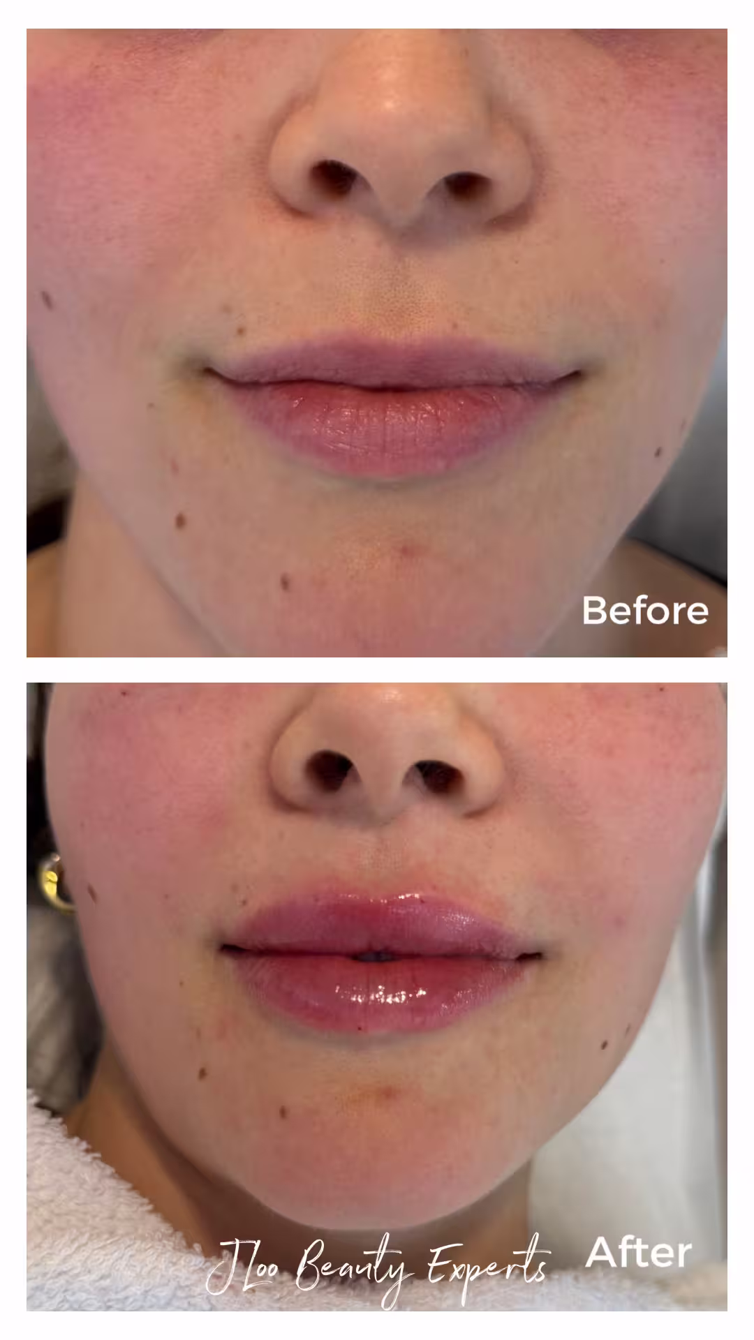 PRF EzGel bio-filler before and after results at JLoo Beauty Experts, Midtown Manhattan NYC