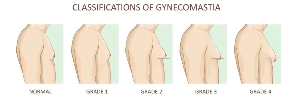 Illustrated chart showing male chest profiles from normal through gynecomastia grades 1 to 4