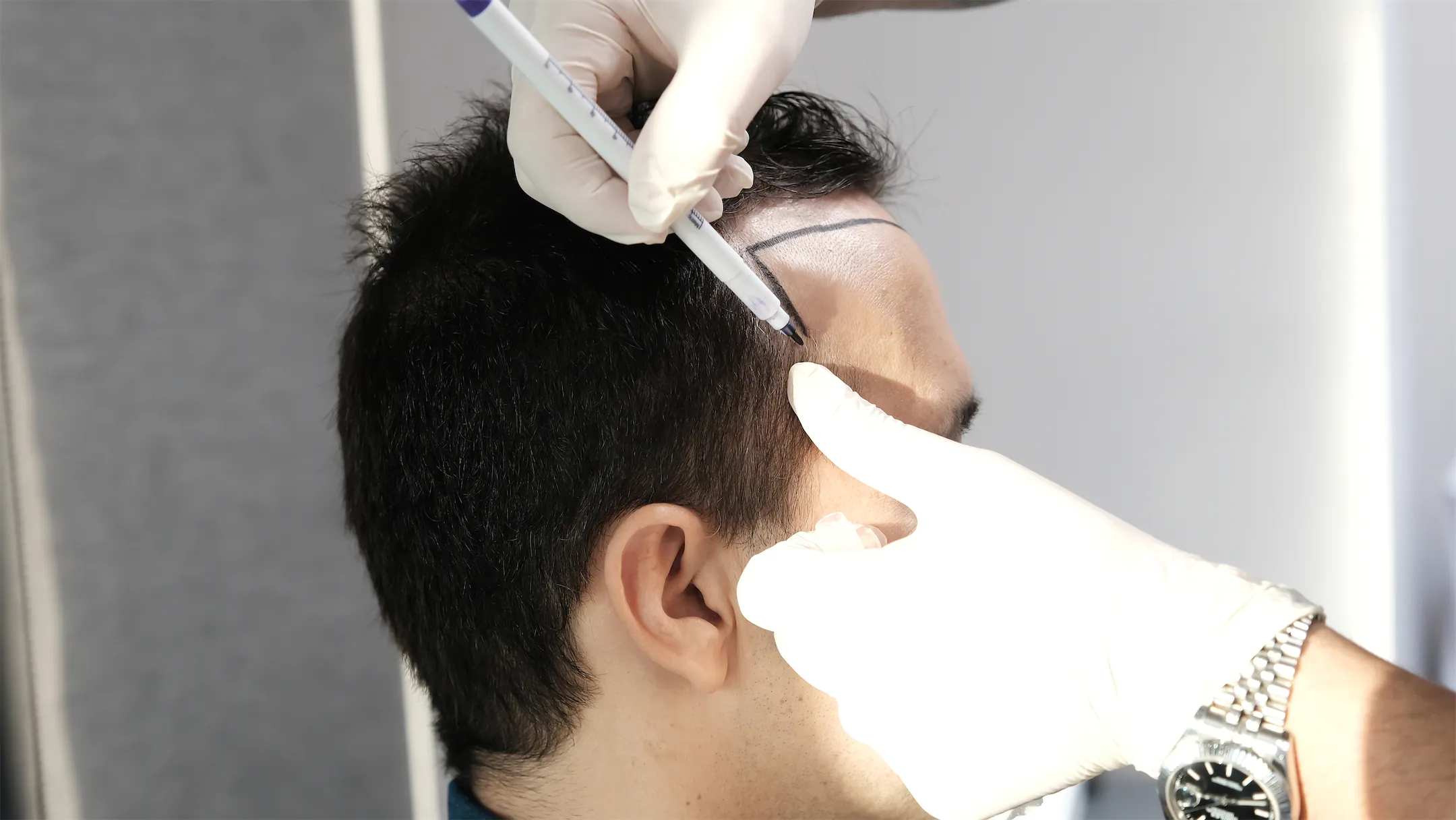 Gloved provider marking a man's hairline with a surgical pen