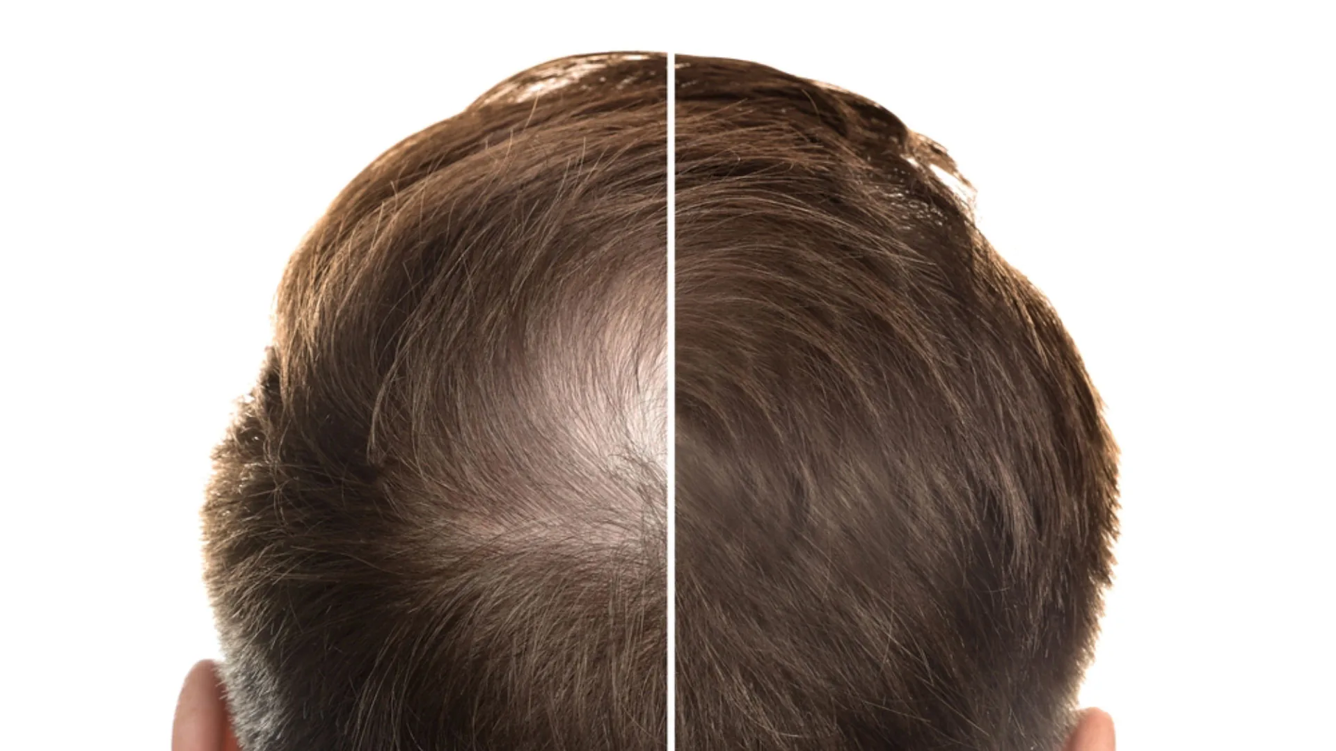 Top of a man's head, split to compare a thinning crown with fuller hair