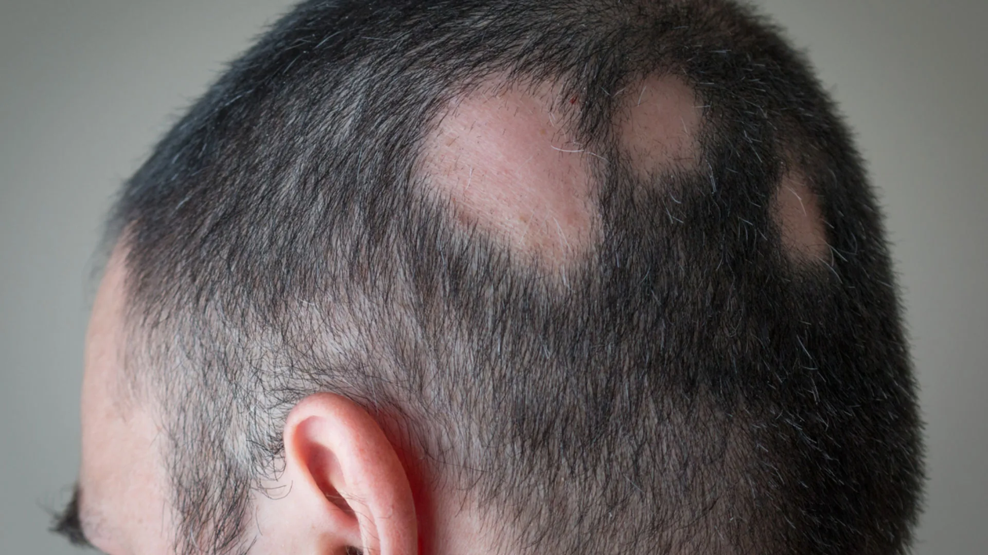 Side view of a man's head showing patches of hair loss