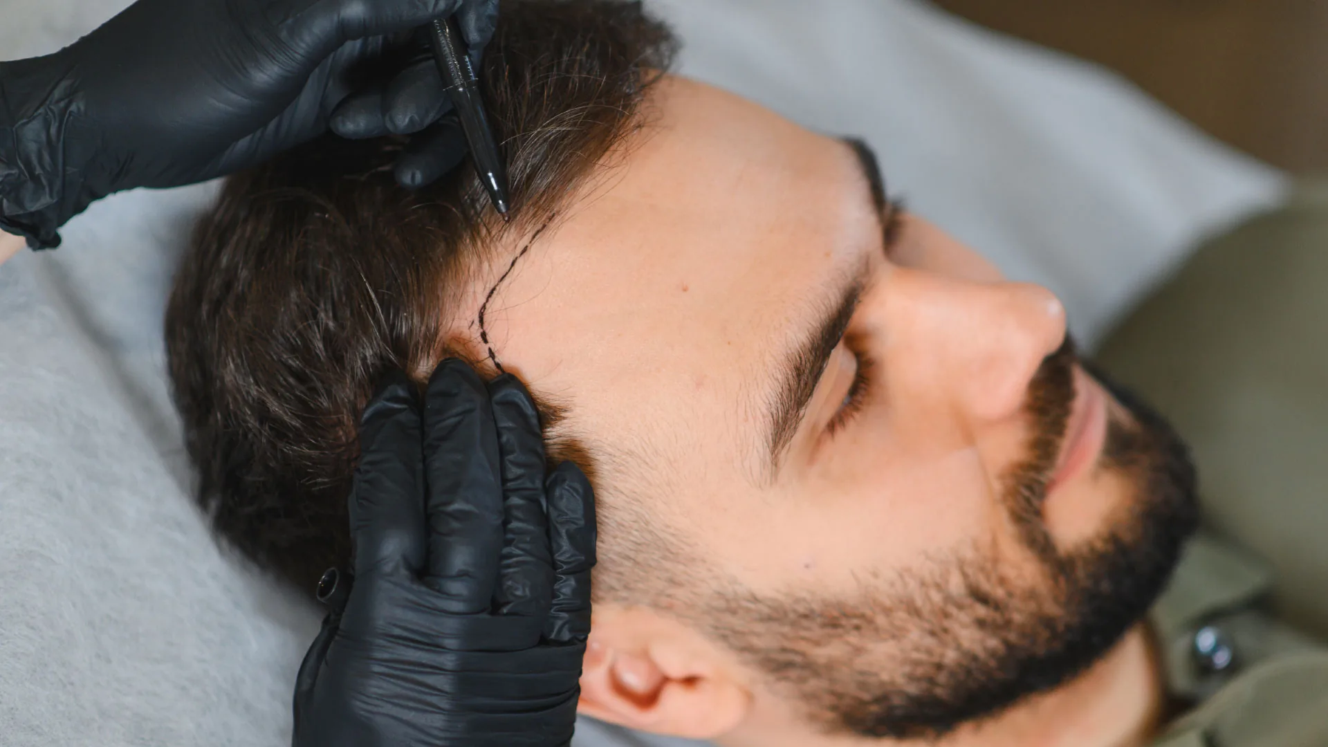 Gloved provider marking a man's hairline with a pen as he lies back