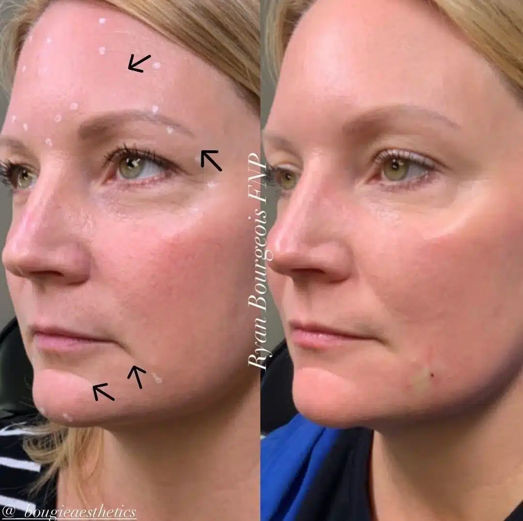 botox-before-and-after-bougie-aesthetics-1.jpeg