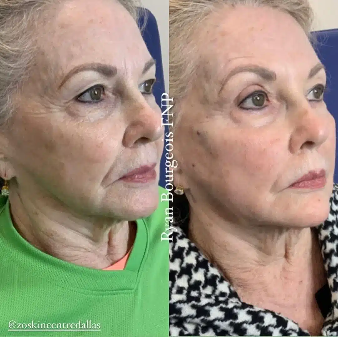 pdo-theads-before-after-bougie-3.jpeg