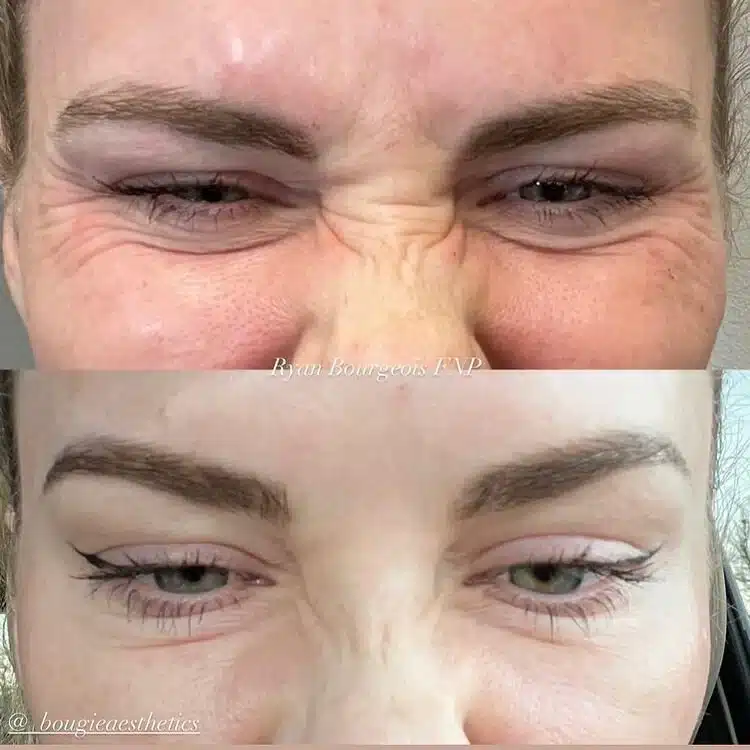 botox-before-and-after-bougie-aesthetics-2.jpeg