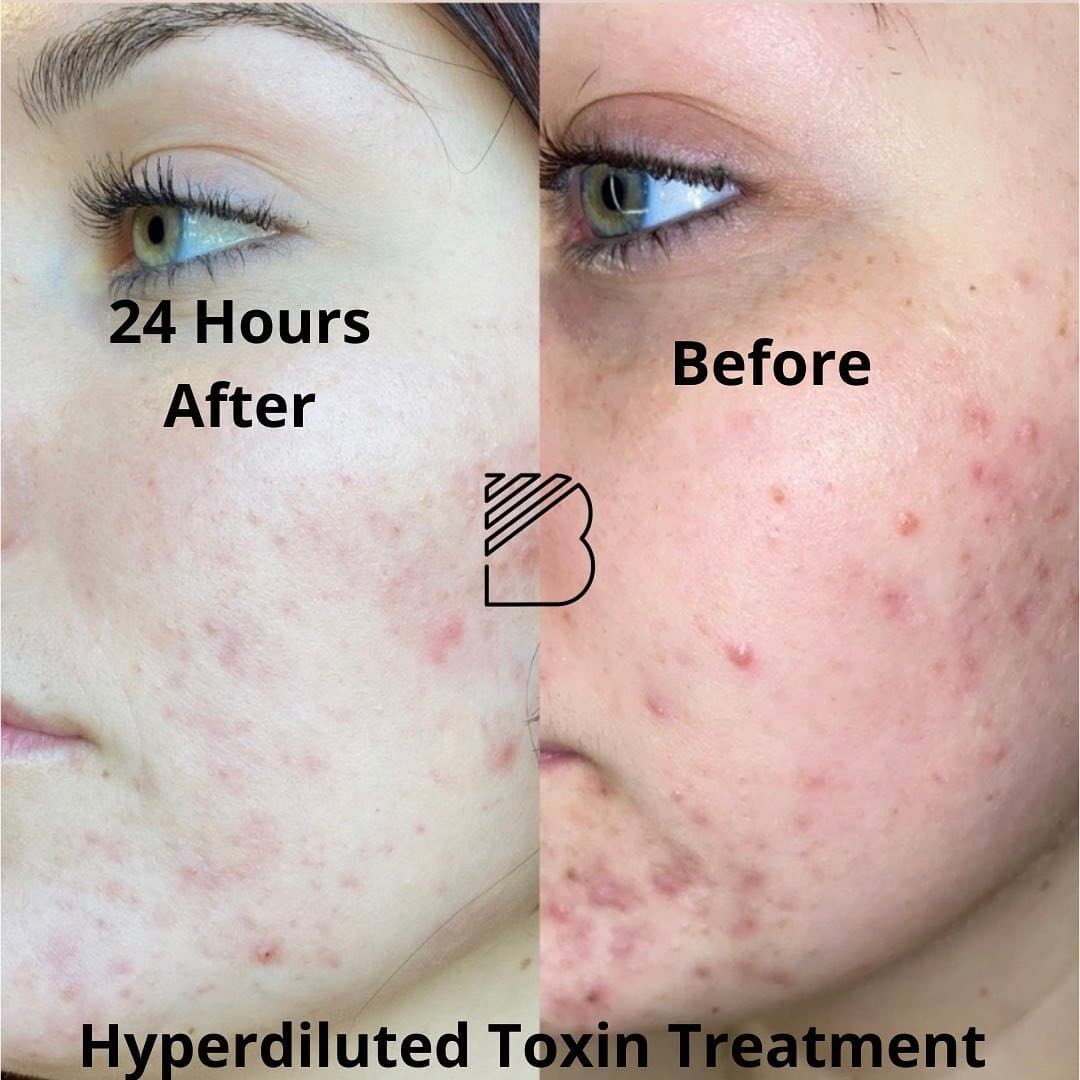 xeomin acne before after bougie aesthetics