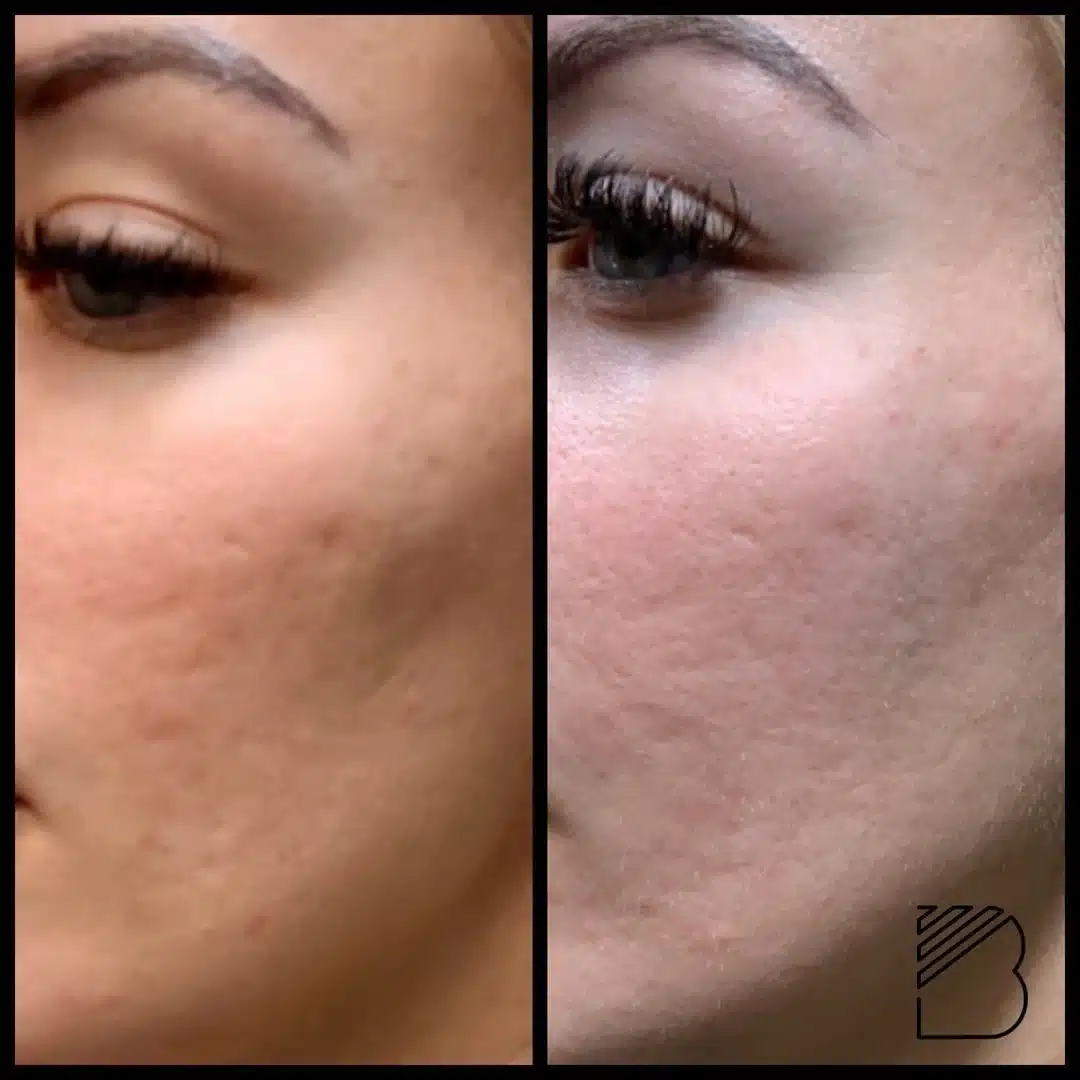 Bougie RF Microneedling before after