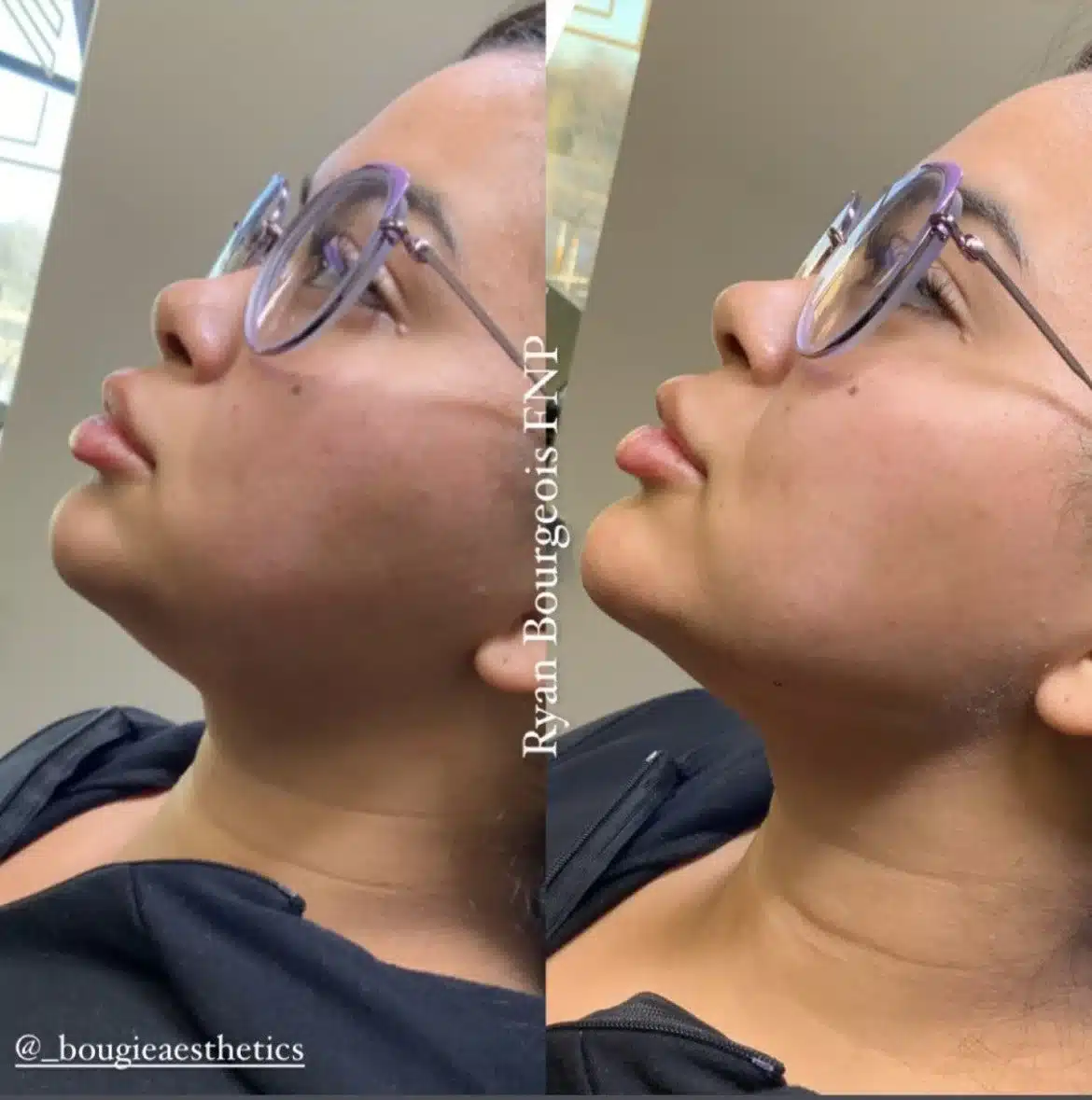 bougie jawline 3