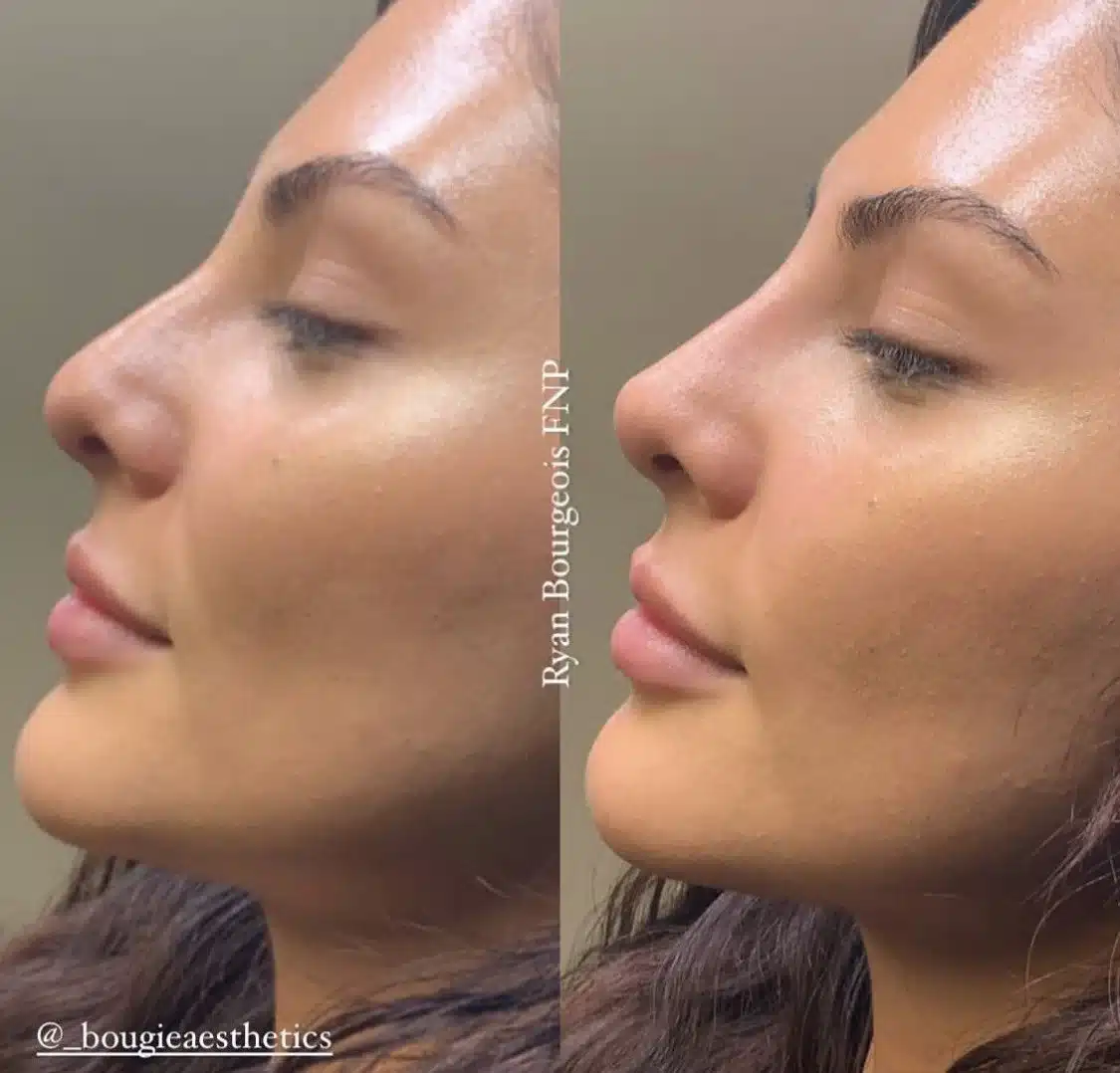 bougie nose 1