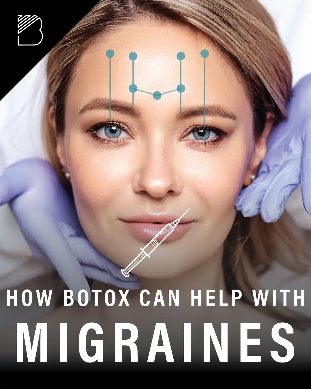 botox for migraine relieve available at Bougie Aesthetics