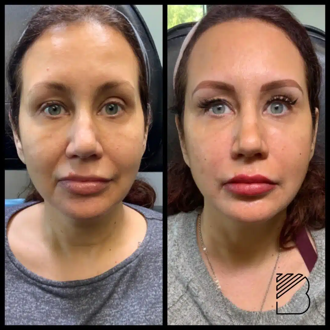 bougie sculptra before and after1