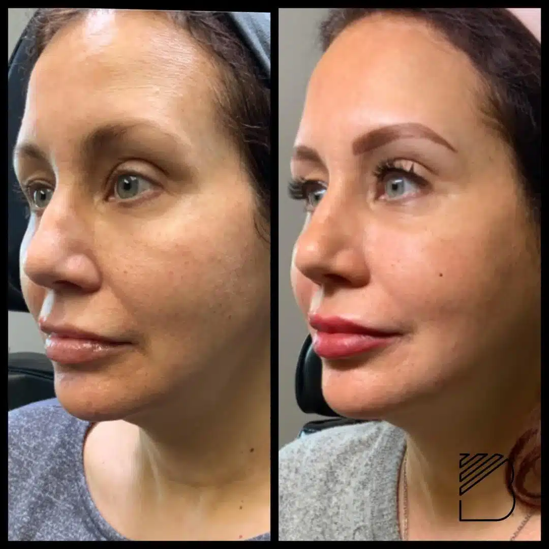 bougie sculptra before and after2