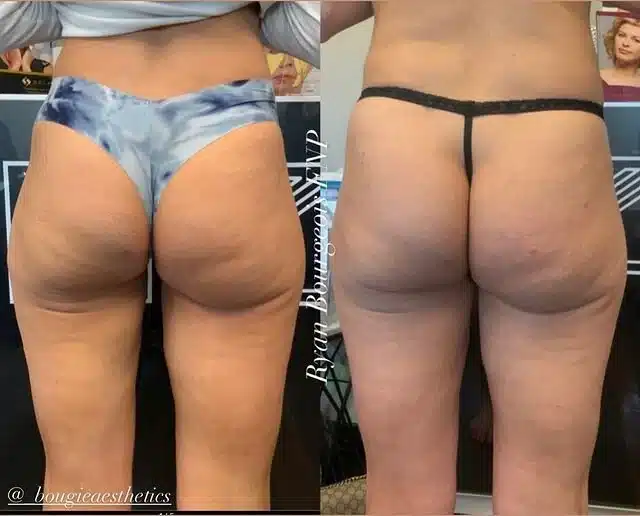 sculptra-bbl-bougie-aesthetics-fort-worth-tx.jpeg