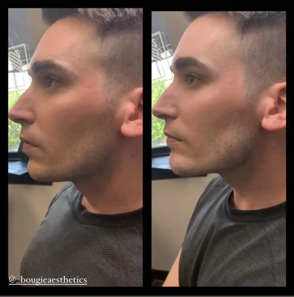 bougie jawline 1
