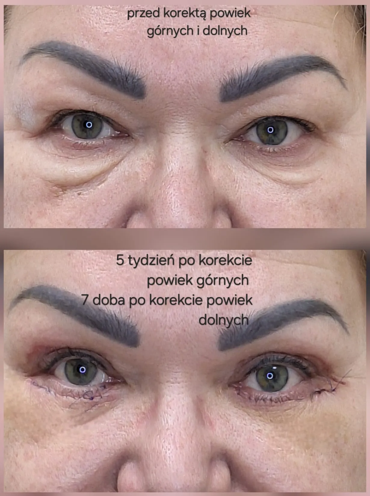 Korekta powiek górnych i dolnych, 5-7 tydzień po zabiegu