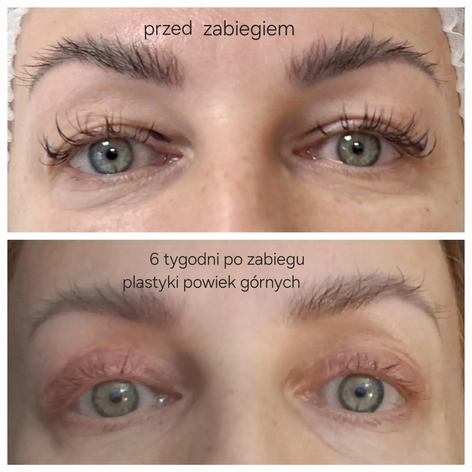 Plastyka powiek górnych, 6 tygodni po zabiegu