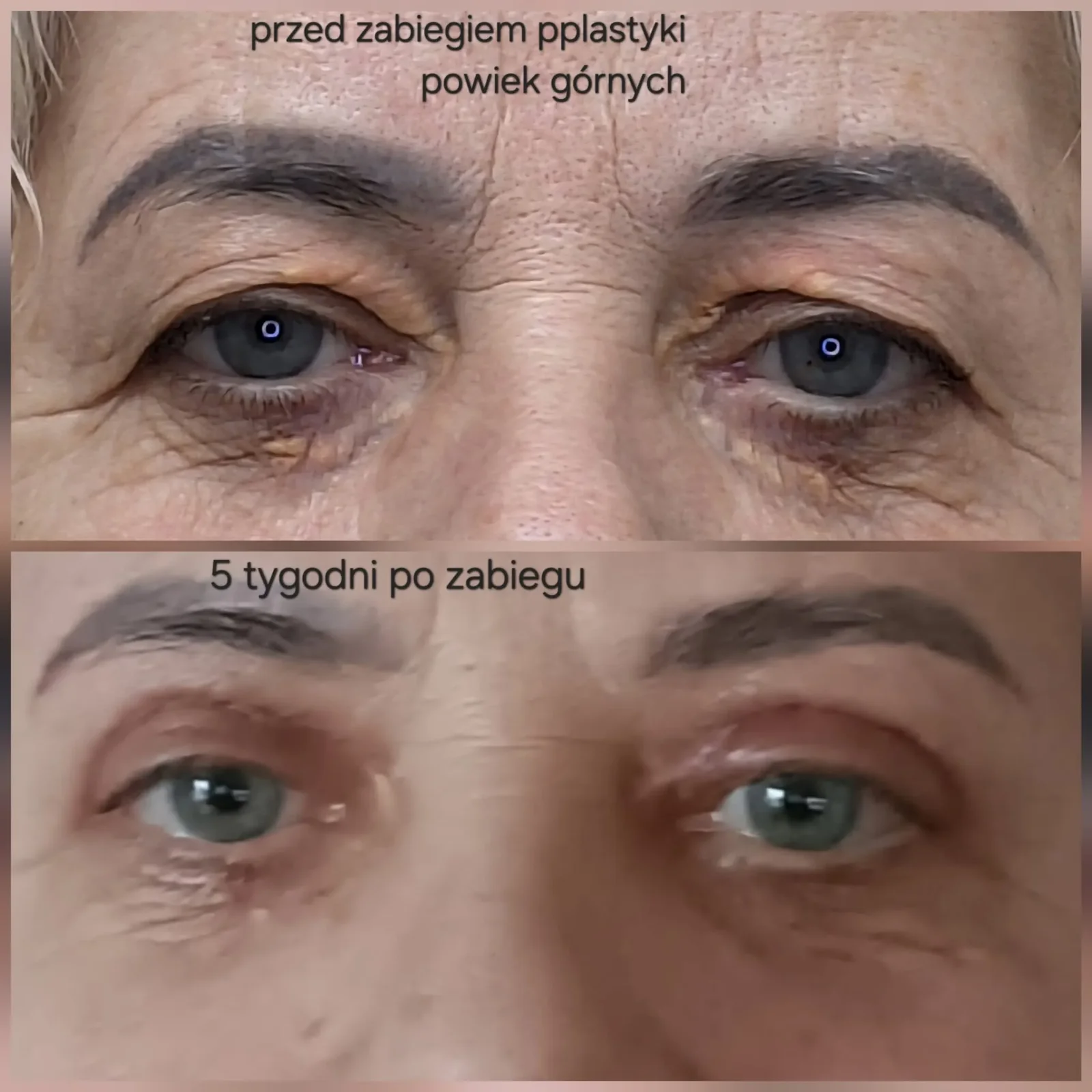 Plastyka powiek górnych, 5 tygodni po zabiegu