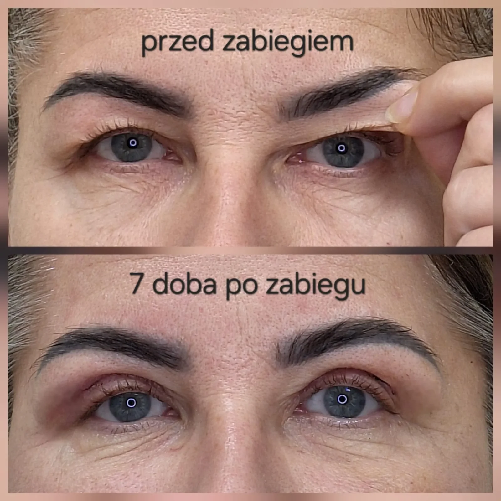 Przed zabiegiem i 7. doba po zabiegu, plastyka powiek