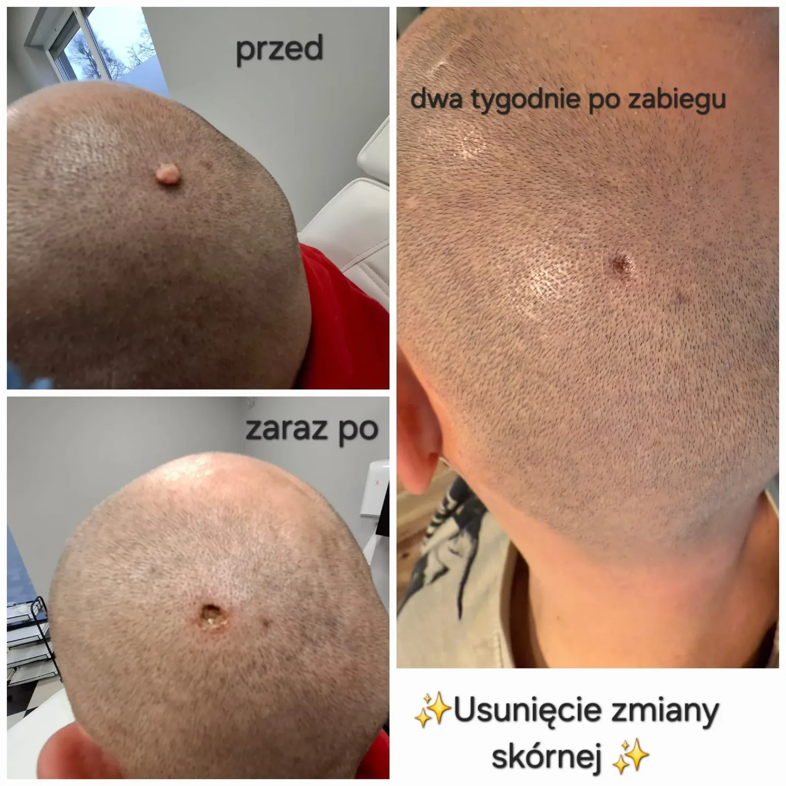 Zabieg fibryną bogatopłytkową, wsparcie regeneracji tkanek, Medical Est