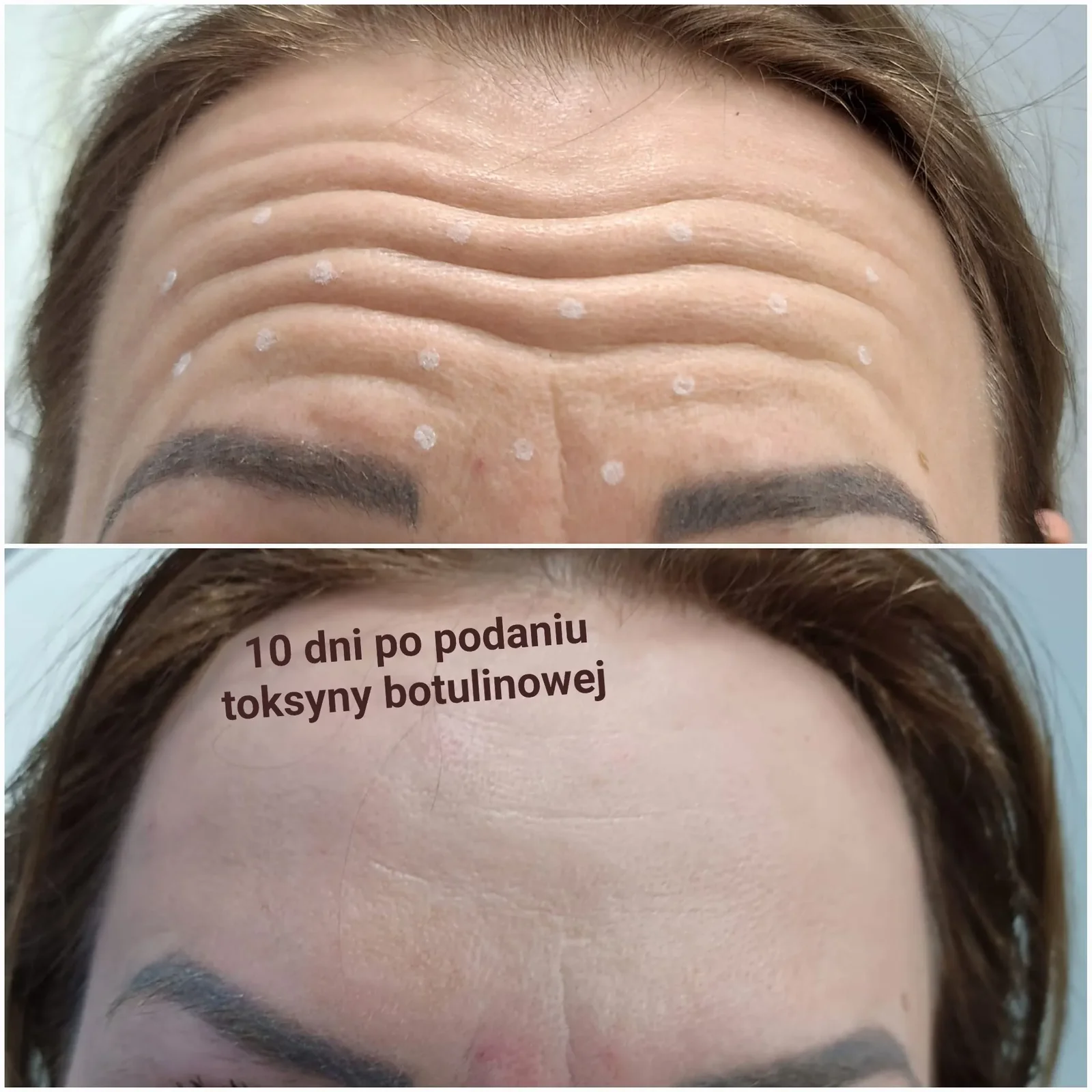 10 dni po podaniu toksyny botulinowej, Medical Est