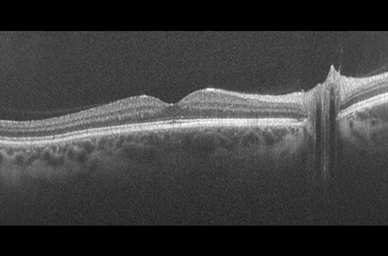 OCT retinal scan showing a cross-section of the retina layers and macula
