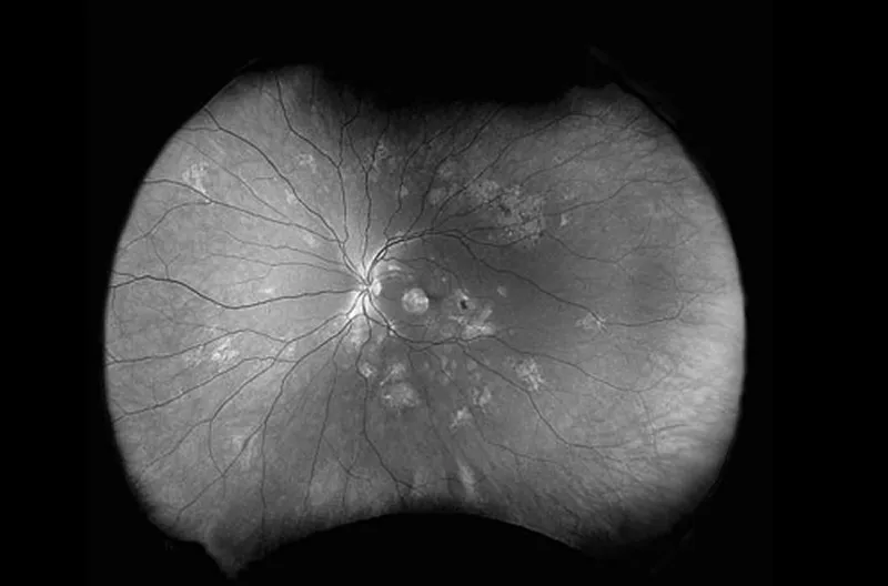 Grayscale wide-field retinal scan showing the optic disc, blood vessels, and scattered lesions