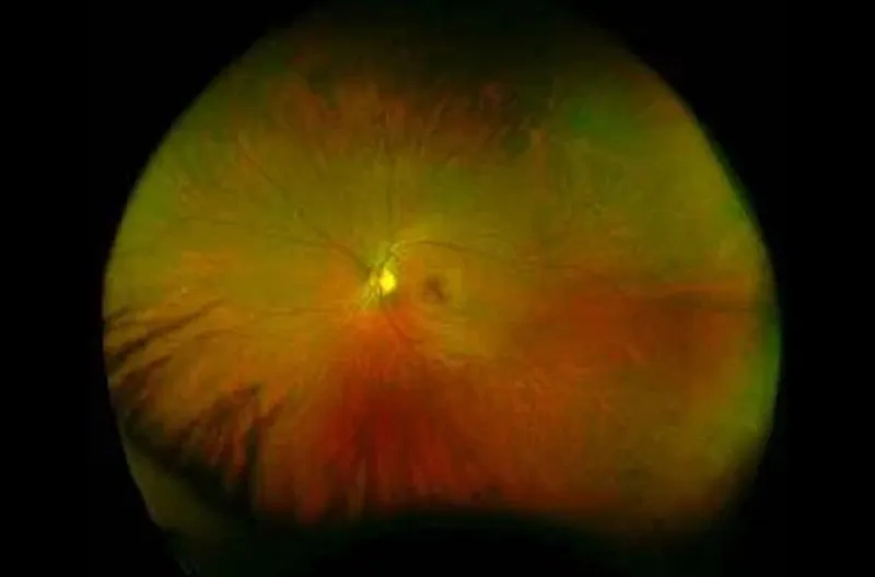 Colour wide-field retinal image showing the optic disc, blood vessels, and areas of red and green pigmentation