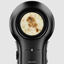 Dermatoscopic examination of skin for early signs of skin cancer