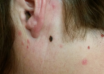 Skin Cancer Types