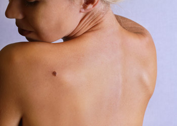 What You Need to Know About Skin Cancer