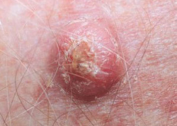 Squamous Cell Carcinoma (SCC)