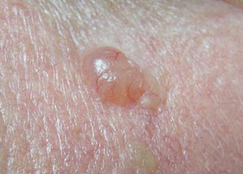 BCC skin cancer lesion