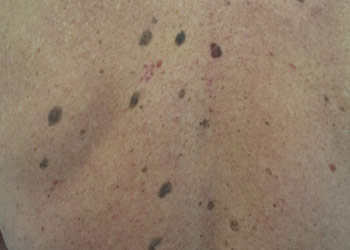 Melanoma warning signs on skin