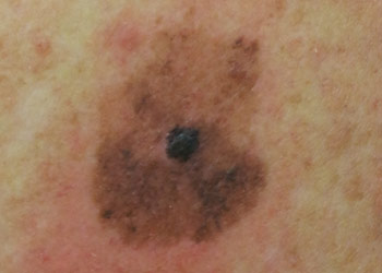 Skin showing melanoma growth