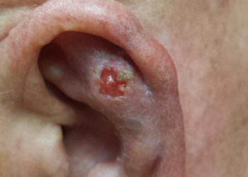 Basal cell carcinoma on ear