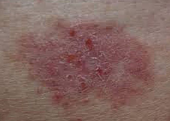 Basal cell carcinoma on skin