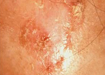 Close-up of solar keratosis on UV-damaged skin