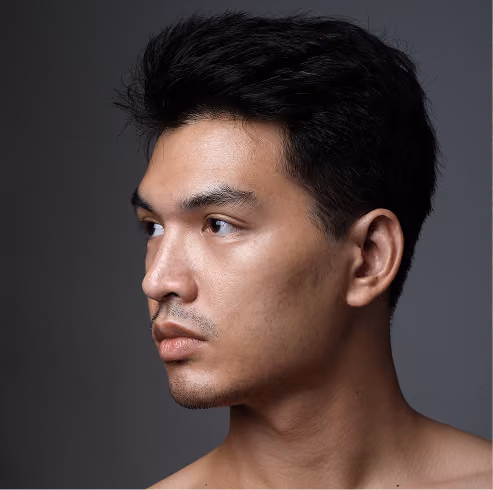 Natürliches Ergebnis nach Rhinoplastik bei einem jungen Mann