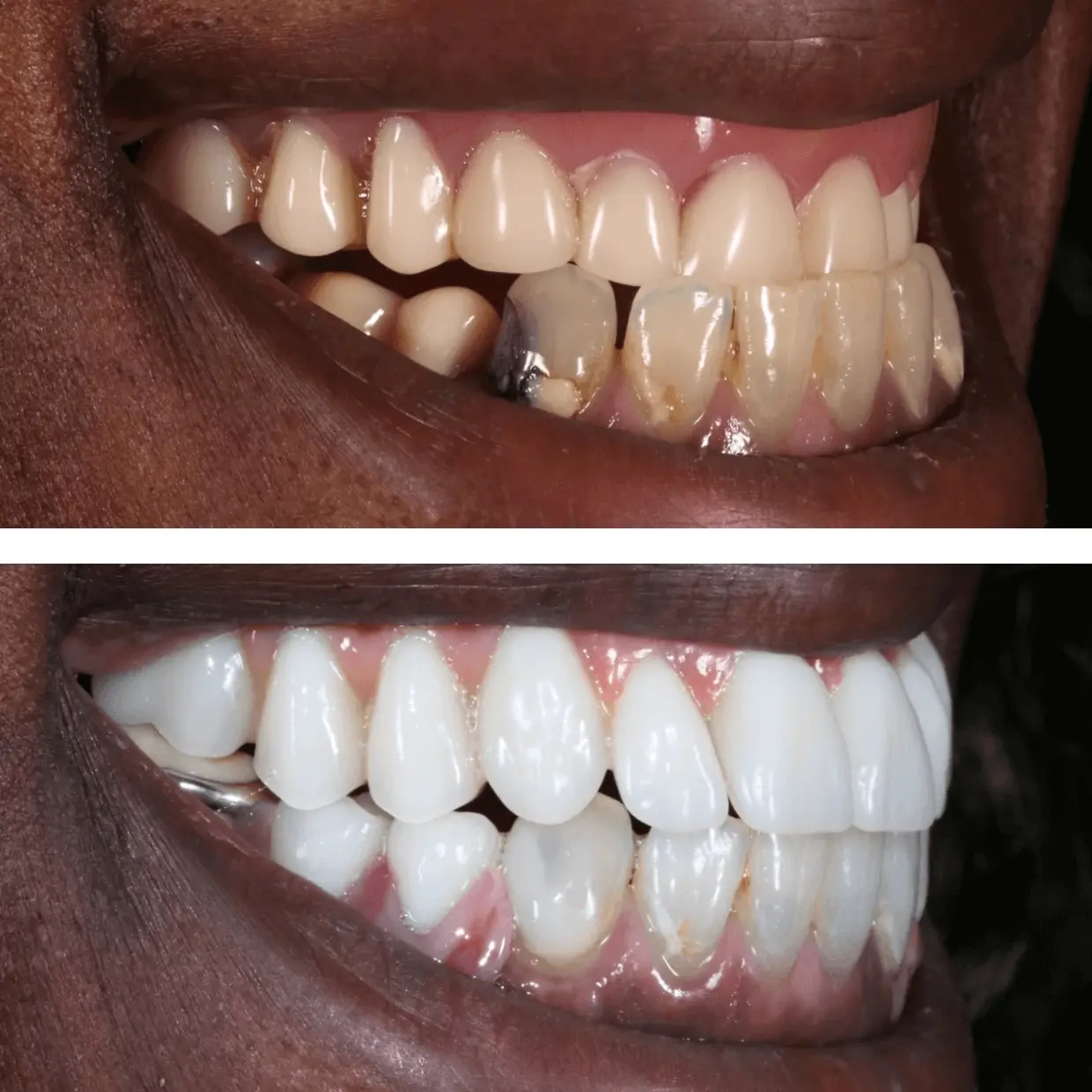 Side-by-side close-up of a person's teeth showing severe discoloration and decay before dental treatment, and clean, white teeth after treatment.